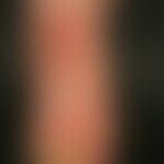 Thomson's syndrome: Massive, chronically stationary hyperkeratosis on the right sole of the foot,...