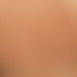 Striae cutis distensae: Fresh, red striae running across the back in fast-growing adolescent pati...