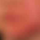 Tinea faciei: 7 Wochen zuvor wurde ein Streichelzoo besucht. Großflächige, zirzinäre randbetonte,...
