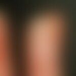 Verrucae vulgares. Exophytisch wachsendes Warzenbeet mit subungualer Infiltration an der Fingersp...