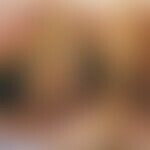 Verbrennung: schwere Verbrennungen 4. Grades am Gesäß einer 23-jährigen Frau nach gynäkologischer...