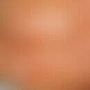 Staphylococcal Scalded Skin Syndrome. Flächiges Erythem, subkorneale Blasen mit groblamellöser Ab...