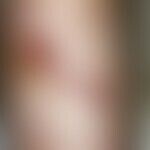 Lymphoma, cutaneous B-cell lymphoma. multiple, since 3 months increasingly growing, chronically d...