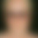 Masern. Fieber bis 40 °C, Rhinitis, Konjunktivitis, Lichtscheu, Pharyngitis. Am 3.-4. Krankheitst...