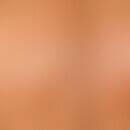 Pseudomonas-Follikulitis: Übersichtsaufnahme: Stammbetontes (insbes. lateral), juckendes, makulop...