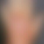 Eczema, contact eczema, allergic. confluent blisters and blisters in the area of the back of the ...