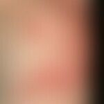Contact dermatitis allergic: Acutely appeared, large red spots and plaques with rough, partly sca...