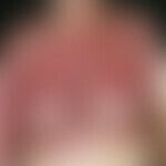 Contact dermatitis allergic: multiple, acute, continuously progressive for 4 weeks, large, isolat...