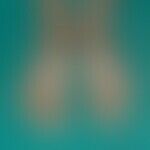 Eczema, contact eczema, allergic: chronic contact allergic eczema caused by wearing chromate-hlat...