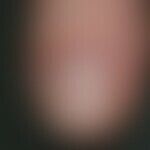 Erythronychia, localized longitudinal. idiopathic, solitary, painless, red longitudinal striation...