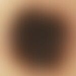 Auflichtmikroskopie, radial streaming. Auflichtmikroskopie: Radial streaming in einem Junktionsna...