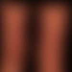 Fibrosis, nephrogenic systemic. large-area, board-hard induration of the hyperpigmented skin with...
