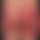 SDRIFE: großflächige, akute urtikarielle Plaques mit unscharfer Berandung. Mit einer gewissen Wah...