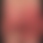 SDRIFE: large, acute urticarial plaques with blurred edges, with a certain probability caused by ...