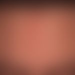 Mosaikdermatose erworbene. In den Blaschko-Linien verlaufende, erworbene, Dermatitis (sog.ILVEN).
