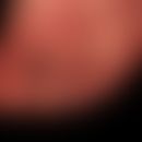 Anonychie erworbene bei Epidermolysis bullosa dystrophica Hallopeau-Siemens
