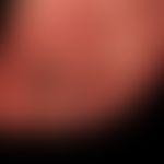 Anonychie erworbene bei Epidermolysis bullosa dystrophica Hallopeau-Siemens
