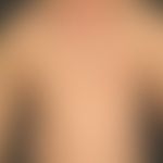 Pemphigus vulgaris (stage of generalisation): multiple, chronic, symmetrical, trunk-accentuated, ...