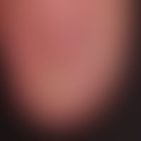 Pterygium unguis: The scarr... Pterygium unguis: The scarred adhesions of the proximal nail fold are clearly recognizable; condi...
