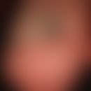 Pincer-nail: Großzehe mit stark gekrümmter und verdickter Nagelplatte.

