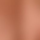 Komedonen und Zysten bei schwerer Acne comedonica: zahlreiche Einfach- (horizontale Pfeile) und D...