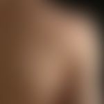Acne comedonica. Zahlreiche Komedonen am rechten Schulterblatt eines 17-jährigen Patienten. Seit ...