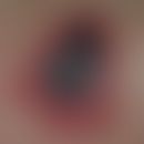 Thrombocytopenia, heparin-induced: Formation of a so-called heaparinecrosis with extensive, painf...