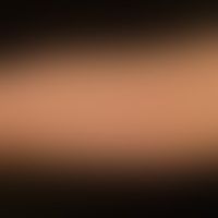 Lichen planus exanthematicu... Lichen planus exanthematicus: an itchy exanthema that has existed for about several months with b...