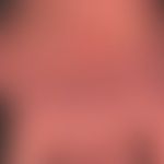 acrodermatitis chronica atrophicans. clear atrophy of the skin with livid, unscnarfly limited, ch...