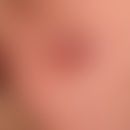 Primär kutanes B-Zell-Lymphom follikuläres. Fester, deutlich über das Hautniveau erhabener, inner...