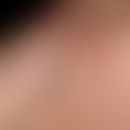 Apokrine Hidradenome: rötliche bzw. bläulich tingierte, feste, völlig symptomlose, scharf begrenz...