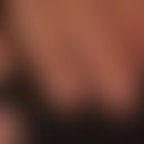 Graham-Little syndrome: pronounced scarring (10 nail) onychodystrophy and lymphocytic, scarring a...