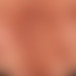 Pemphigus vulgaris: multiple, chronic, inflammatory plaques that have been running in phases for ...