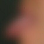 Hair leukoplakia orale. "Classic finding" with completely sympotmless, not strippable, flat, whit...