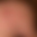 Zoster ophthalmicus: since a few days increasing, left-sided headache with little feeling of illn...