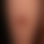 Primary cutaneous marginal zone lymphoma: painless brown plaque with central nodular formation th...