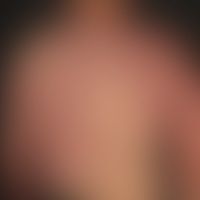 Vascular twin naevus (Naevu... Vascular twin naevus (Naevus vascularis mixtus): Kombination eines Naevus flammeus mit einem Nae...