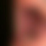 Pemphigus vulgaris: chronically persistent, extensive, painful erosions of the cheek mucous membr...