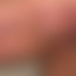 Striae cutis distensae: old and fresh (red) striae in obesity permagna and long-term internal and...