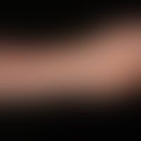 Naevus anaemicus: angeboren... Naevus anaemicus: angeborene, randlich unregelmäßig zergliederte, weiße, glatte Flecken. Nach Rei...