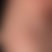 Naevus anaemicus: angeboren... Naevus anaemicus: angeborene, randlich unregelmäßig zergliederte, weiße, glatte Flecken. Nach Rei...