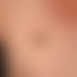 Melanom malignes superfiziell spreitendes: Außergewöhnliche großes, 6,0x4,0 cm durchmessendes, ma...