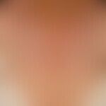 Vitiligo (detailed picture): Therapy-induced (after administration of a checkpoint inhibitor) vit...