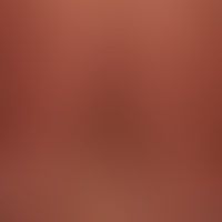 Nappes claires: nahezu eryt... Nappes claires: nahezu erythrodermische poikolodermatische Form der Mycosis fungoides. Spritzerar...