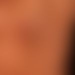 Lichen planus (classic type): for several months persistent, red, itchy, polygonal, partly conflu...