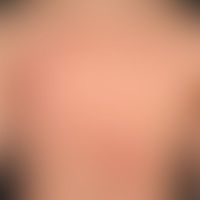 Toxic contact dermatitis: 4... Toxic contact dermatitis: 42-year-old patient who noticed these painful, red plaques after accide...
