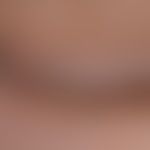 Vitiligo: infestation of the eyelids and the adjacent cheek area. spot-shaped repigmentation. def...