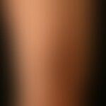 Dermatitis, hypereosinophile: generalisiertes, teils papulöses, teils plaqueartiges, erheblich ju...
