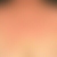 Extrinsic atopiceczema: emi... Extrinsic atopiceczema: eminently chronic, somewhat asymmetrical eczema with blurred, itchy, red,...
