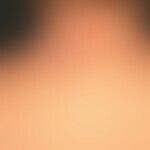 Extrinsische atopische Dermatitis: eminent chronisches, etwas  asymmetrisches Ekzembild mit unsch...